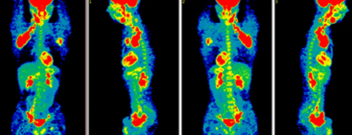 A three-dimensional PET scan with visible tracer uptake in multiple lymph nodes