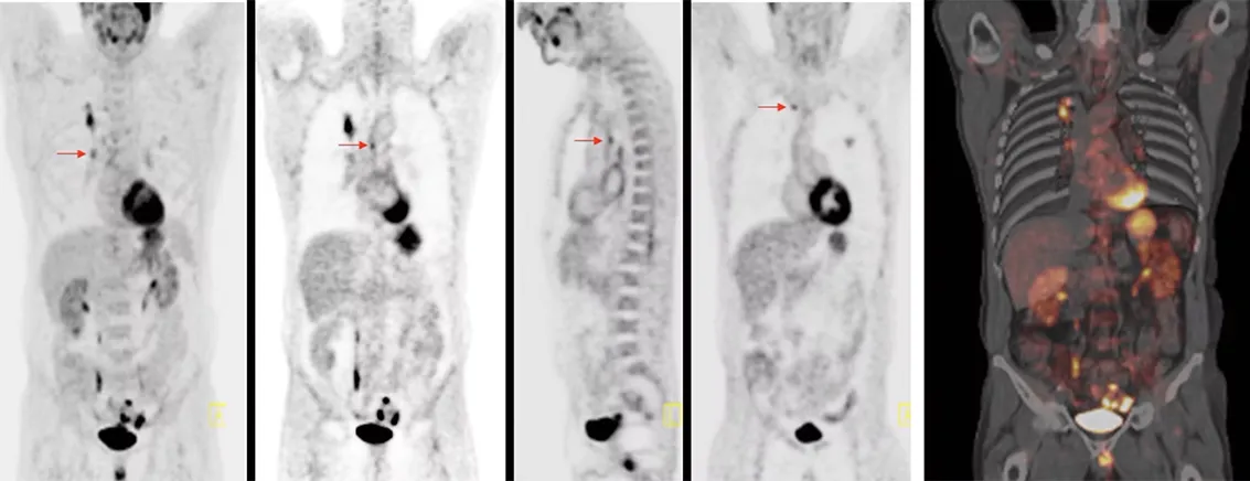 Lung Cancer with Small Mediastinal Lymph Node Metastases