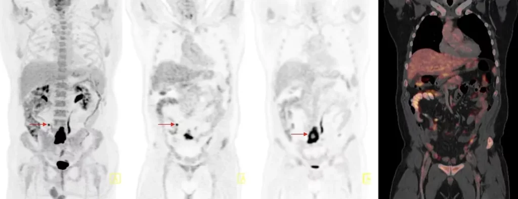 Lymphoma with visible tracer uptake in multiple lymph nodes